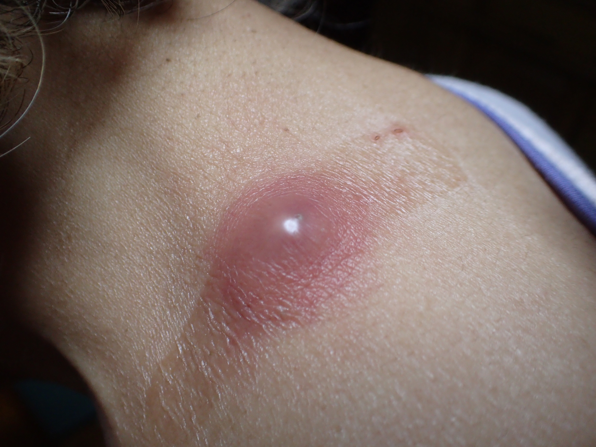 皮膚腫瘍（できもの）