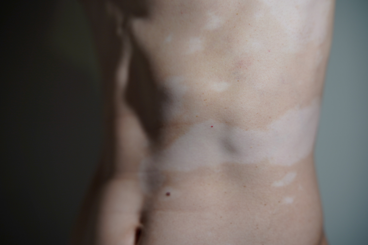 尋常性白斑（白なまず）