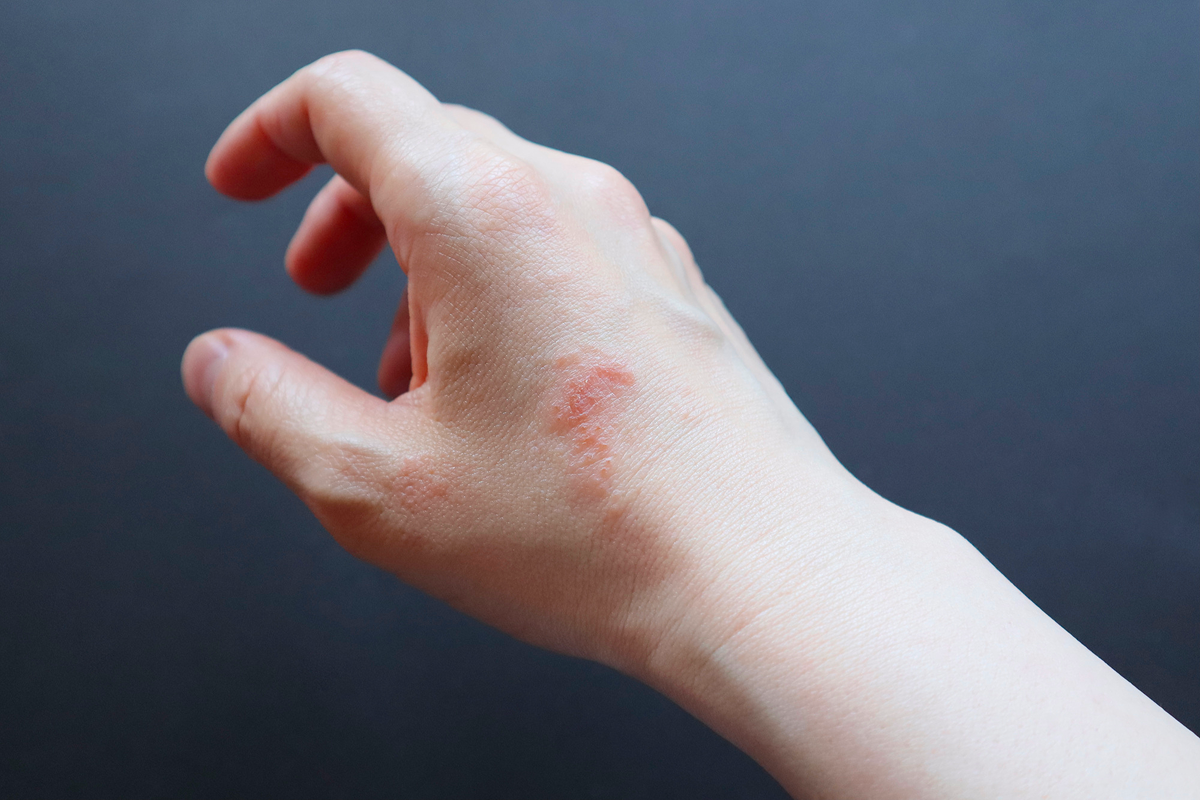 伝染性膿痂疹（とびひ）